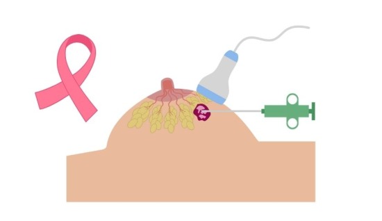 Meme Kanseri Tanı Yöntemleri – Biyopsi