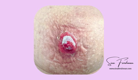 Meme Ucunda Egzama, Kızarıklık ve Yara Kanser Habercisi Olabilir