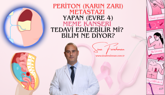 Meme Kanseri Karın Zarı (Periton) Metastazı Nedir? Belirtiler ve Tedavi