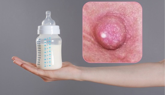 Süt İncisi (Bleb) Nedir? Nasıl Tedavi Edilir?