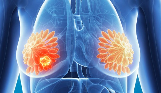 Invaziv Duktal Karsinom (IDK): Detaylı Rehber