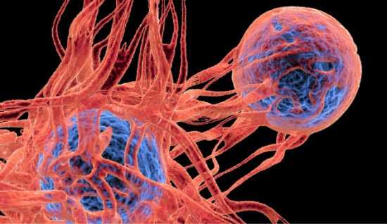 Invaziv Lobüler Kanser (ILK): Detaylı Rehber