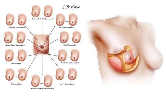 Onkoplastik Meme Ameliyatı: Kadrana Göre Cerrahi Seçim