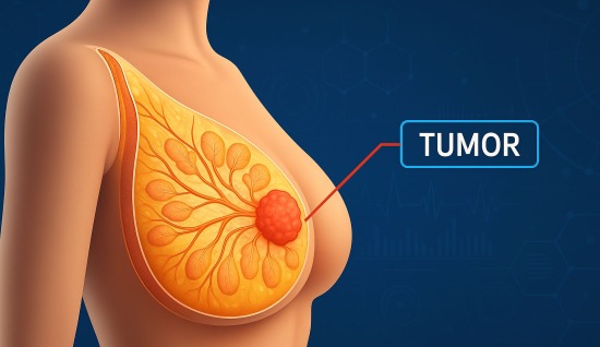 Meme Kanseri Nedir ?