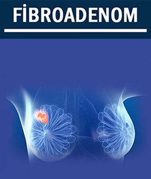 Fibroadenom