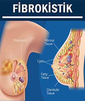 Fibrokistik Meme Hastalıkları
