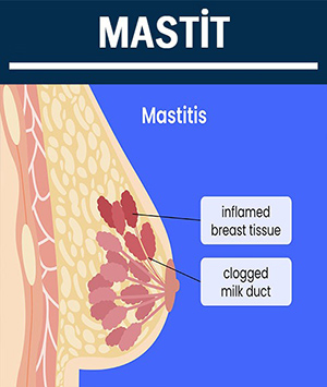 Meme Enfeksiyonları (Mastit)