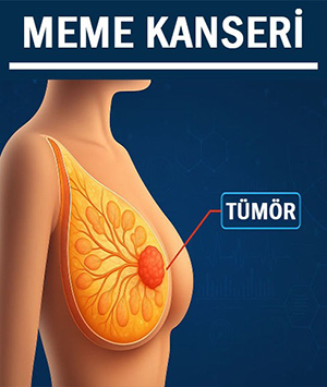 Meme Kanseri